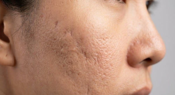 Acne scarring on cheek skin