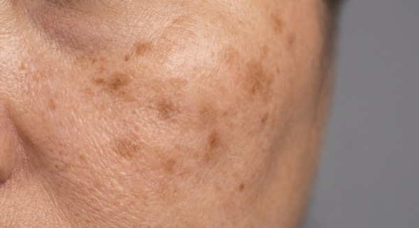 Facial pigmentation and sunspots on skin