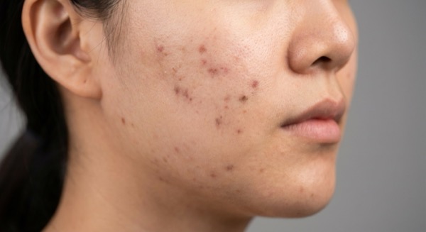 Post-inflammatory hyperpigmentation marks on skin
