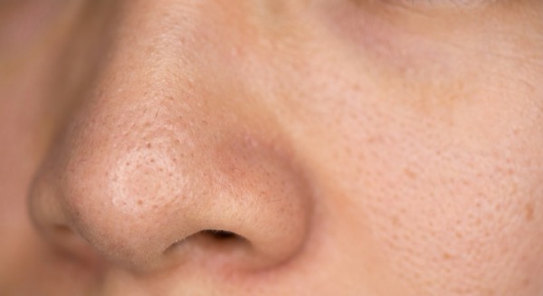 Enlarged pores on nose and cheek