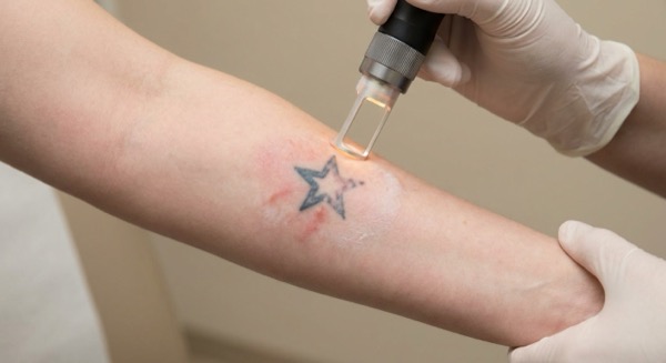Tattoo removal laser treatment in progress